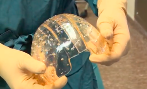 Here's the 3D-printed skull implant. (Screengrab: YouTube)