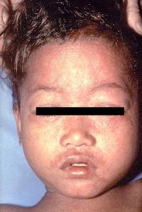 Child with measles rash (Photo: CDC/ Barbara Rice)
