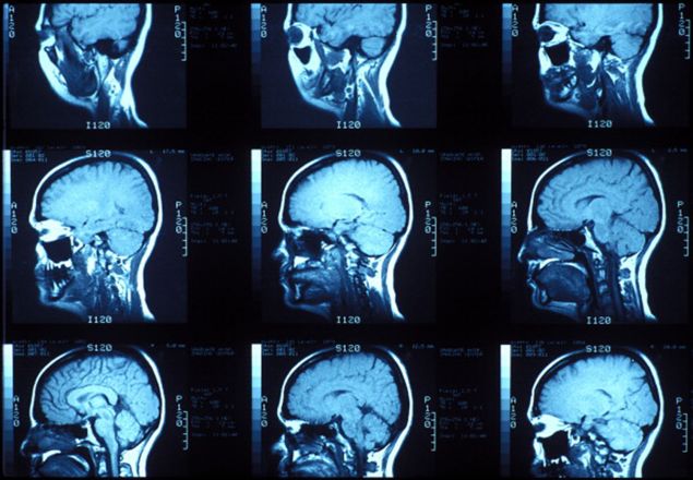 MRI of the lateral skull. (Photo: John Greim/Getty Images)