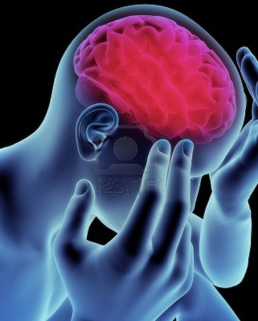 Rendering of a brain affected by Alzheimer's.