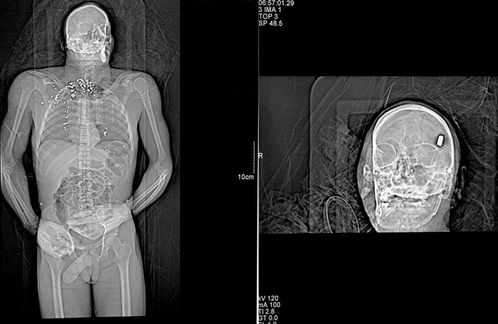 X-Ray of gunshot victims: shotgun blast to chest and throat, bullet to head, Detroit, Michigan. Summary: A Detroit Requiem DetroitÖthe word alone incites many emotions within Americaís conscience.† Detroit was the epicenter for financial equality in the U.S., the home front for the ideal of well-paying jobs for the masses and a political force behind a strong middle class.† Henry Ford made Detroit a boomtown.† Five decades after he started, the boom began to bust.† Many reasons are at the heart of Detroitís decline: postwar industrial policies, urban planning, the 1967 race riots, UAW and auto industry management, Detroitís political cronyism, Clinton era trade deals, and quite possibly the mobility of the automobile itself.† It was the 1950ís when Detroit began the long decay that has brought the city to its present state, a time when Detroit, and America, was at its peak. Today, Detroit is Americaís poorest large city.† To avoid being the nationís perpetual murder capital, the police began cooking stats.† In 2008, they claimed 306 homicides ñ until The Detroit News discovered that there were actually 375.† In more than 70 percent of murders in Detroit, the killer got away with it.† Detroitís East Side is now the poorest, most violent quarter of Americaís poorest, most violent big city.† The illiteracy, child poverty, and unemployment rates hover around 50 percent.† The shooting death of seven-year-old Aiyana Stanley-Jones by police on Detroitís East Side brought national attention to this quarter over the summer of 2010.† But as the spotlight faded, the killings continued. With 103 kids and teens murdered in Detroit between January of 2009 and July of 2010, I was sent to cover the failure of political and civil leaders in Detroit, the failure of industry in Detroit, the failure of the federal government in Detroit, the failure of America in Detroit.