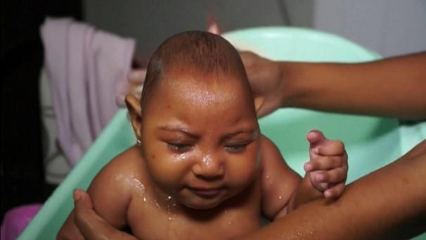 A baby with microcephaly due to Zika virus.