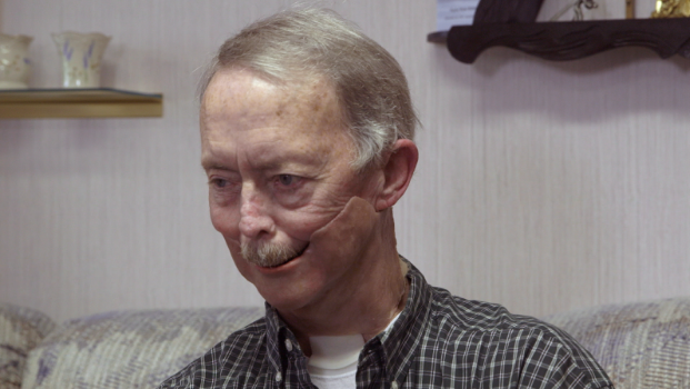 Shirley Anderson fit with his facial prosthesis