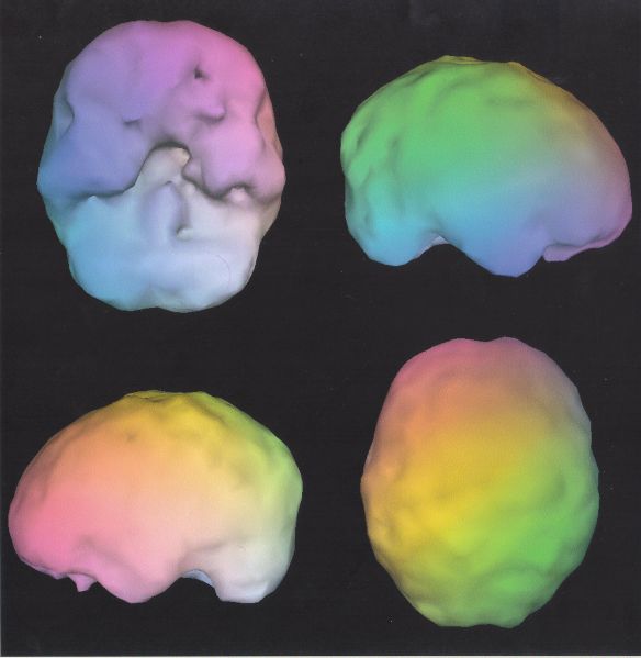 Many neurologists question the value of SPECT scans.