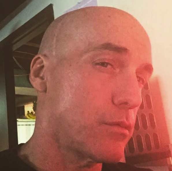 There’s no longer a giant crater on that side of my head, only a nasty scar