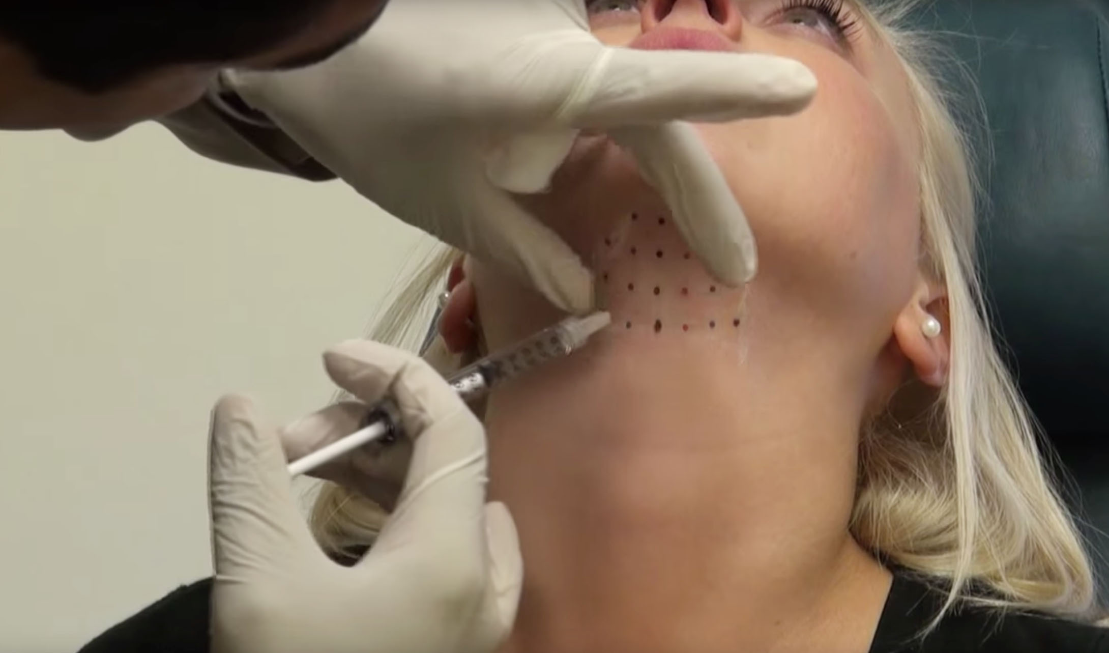 Kybella.
