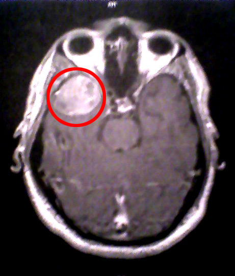The tumor had been growing for an estimated 15-20 years