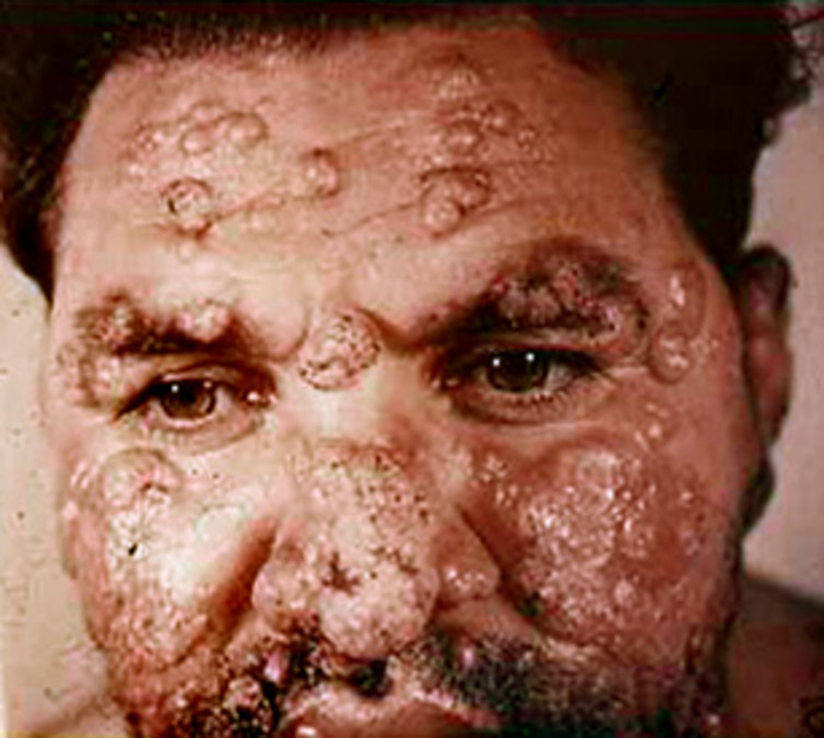 The disfiguring effects of leishmanianism.
