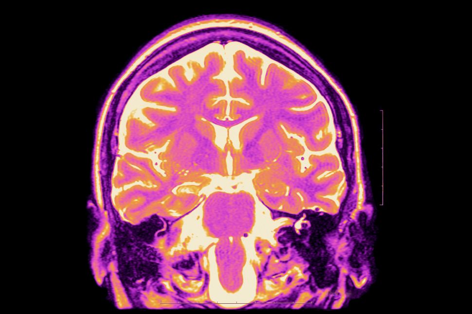 Mri T2, Frontal Cut Away View. Partial Drug Resistant Epilepsy. Right Hippocampal Sclerosis.