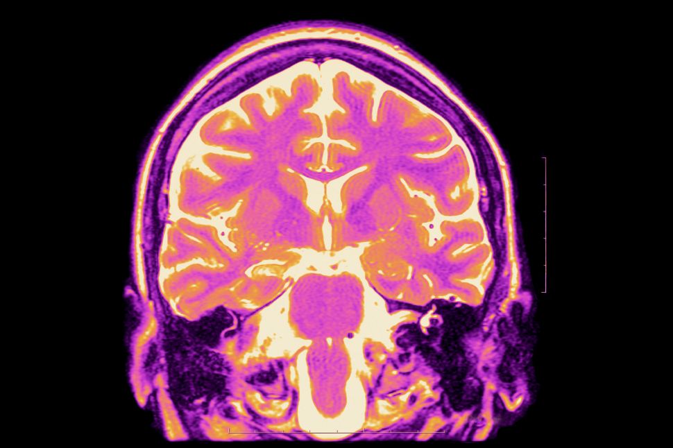 Mri T2, Frontal Cut Away View. Partial Drug Resistant Epilepsy. Right Hippocampal Sclerosis. 